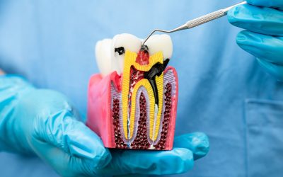 Root Canal Treatment in Karve Nagar Why It’s Not as Scary as You Think