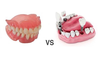 Dental Implants vs. Dentures: Which Is Best for You