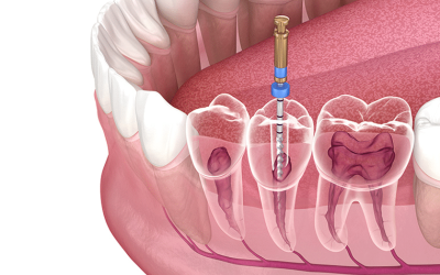 How to Care for Your Tooth After a Root Canal