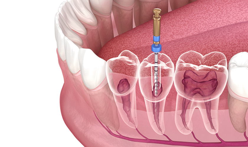 How to Care for Your Tooth After a Root Canal