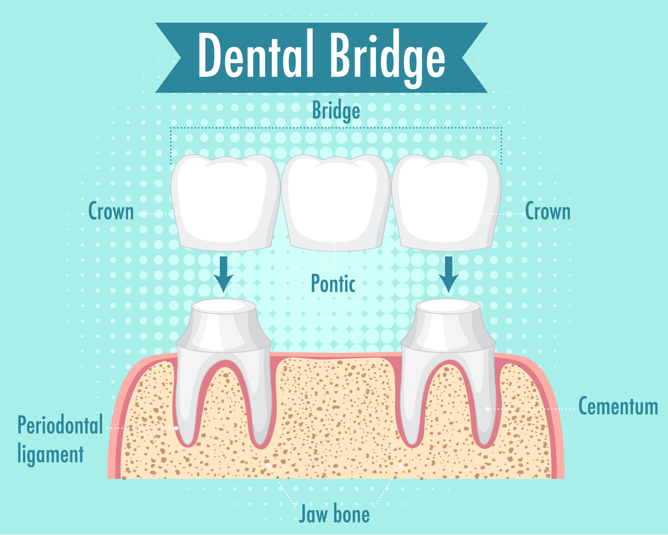 Crowns and bridges treatment at Molar Bear Dental Studio Karve Nagar Pune
