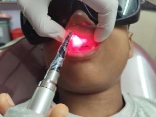 Photobiomodulation therapy for healing and nerve recovery