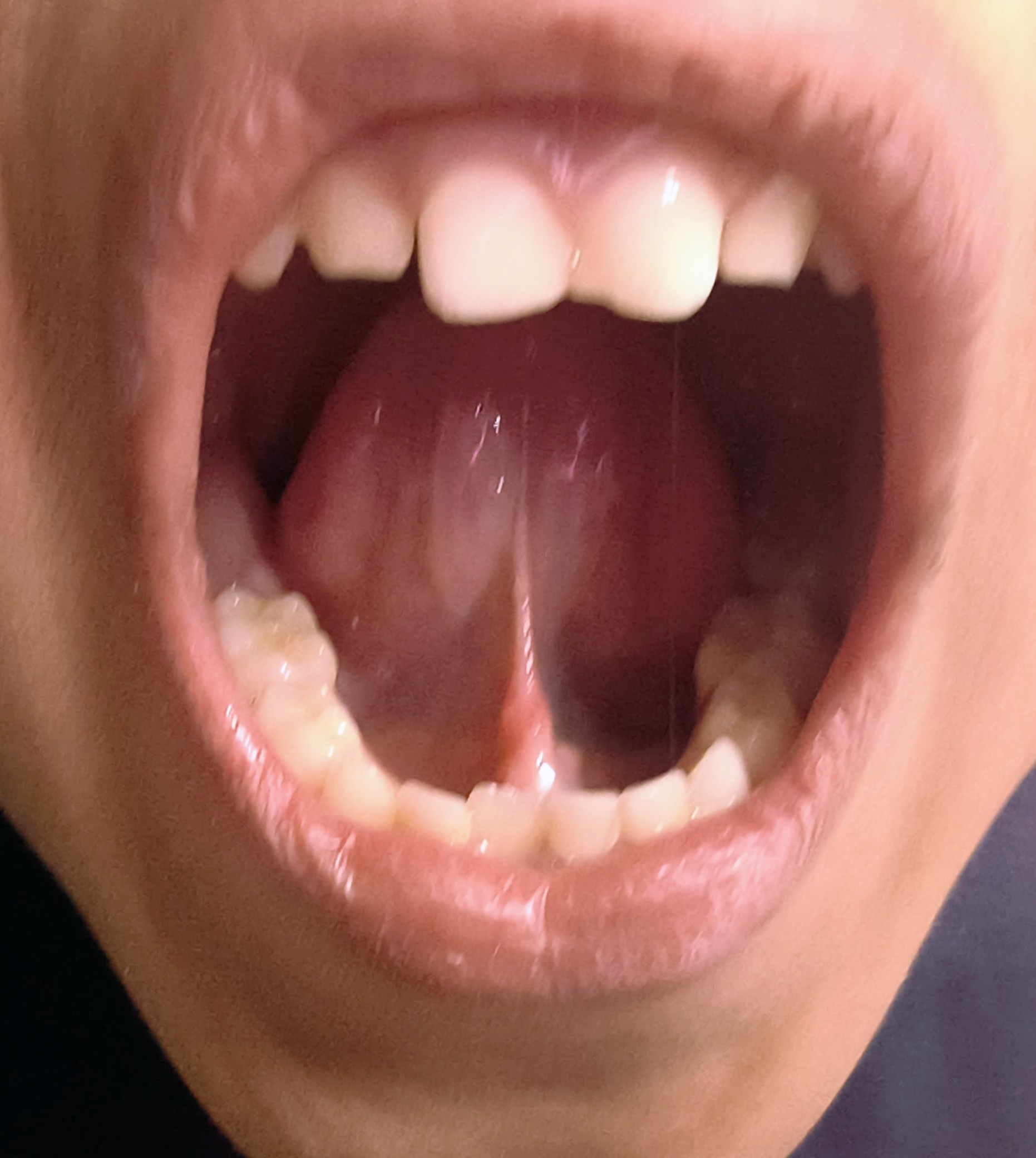 Laser tongue tie treatment in Pune